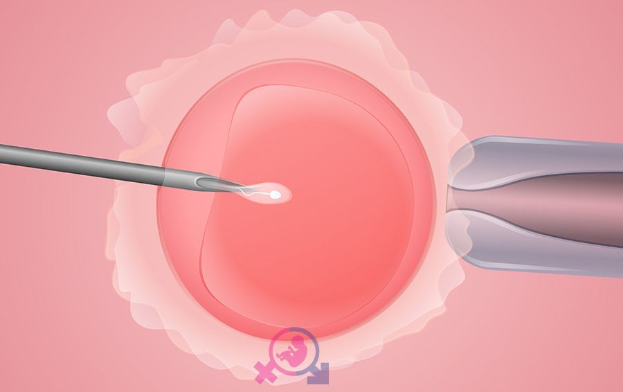 In vitro fertilization это. ИКСИ. ИКСИ ИМСИ. Что такое ИКСИ В гинекологии. Этапы ИКСИ.